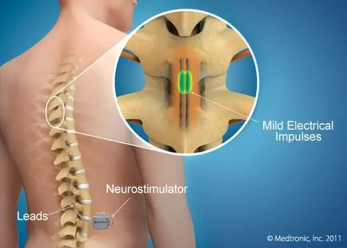 Estimulação Epidural