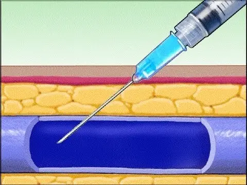 Injeção intravenosa