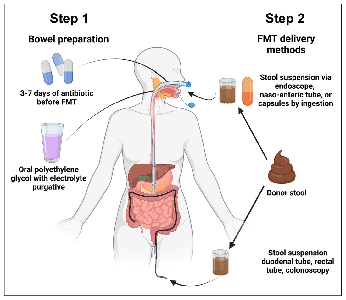 As duas etapas de um transplante de microbiota fecal: preparo intestinal e vias de administração do TMF