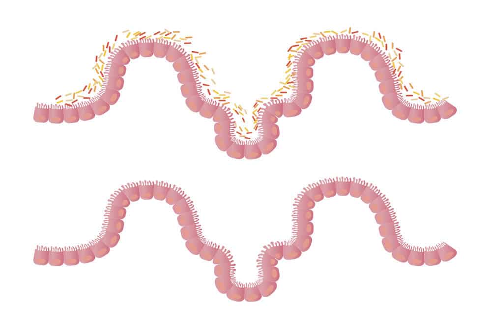 Transplante de Microbiota humana (FMT)